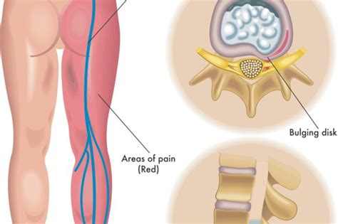 What Is Sciatica Gloucester Chiropractors