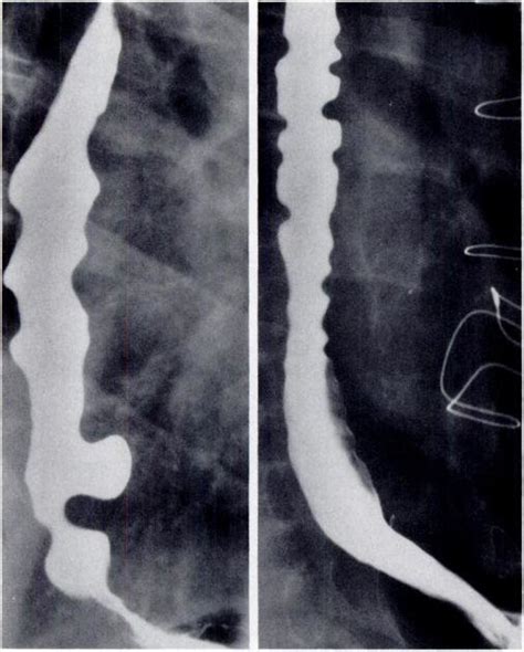 Diffuse Esophageal Spasm DES A Spot Film Of Esophagus In Patient