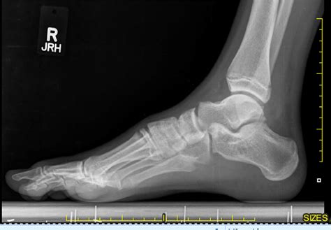 Technique Article Tarsal Coalition Resection Using Kirschner Wires