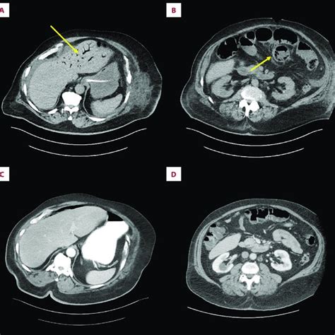 Ct Scans Of Hepatic Portal Venous Gas And Pneumatosis A And B Show The Download Scientific