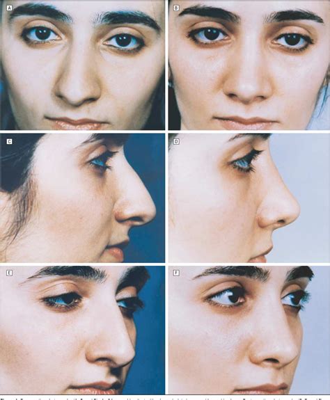 Structure of dorsum of nose | Semantic Scholar