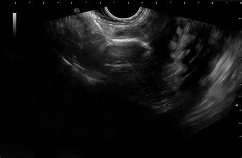 Endoscopic Ultrasound Guided Gastrojejunostomy With Lumen Apposing