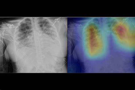 Radiologists use deep learning to find signs of COVID-19 in chest X-rays | Hub