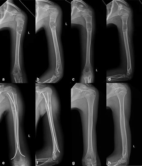 Pathological Fracture