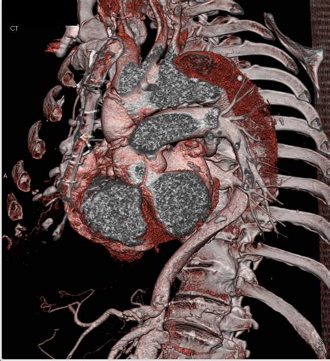 Type A Dissection Extending Into The Abdominal Aorta As Well As Carotid