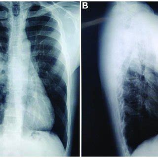 The Patient S Chest Radiography Notes A Posterior Anterior Pa