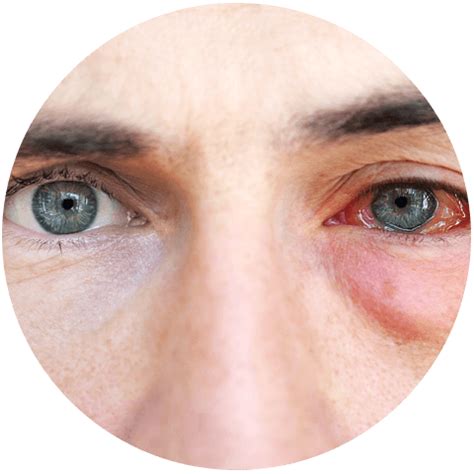 Eye Allergies Treatment | North Brunswick, NJ | Somerset Eye Care