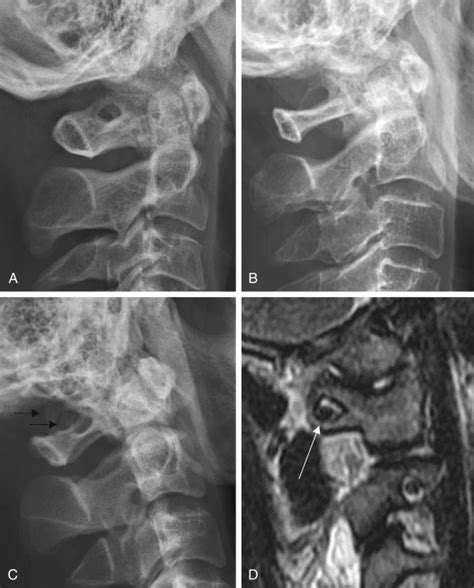 Imaging Of The Craniovertebral Junction Radiology Key