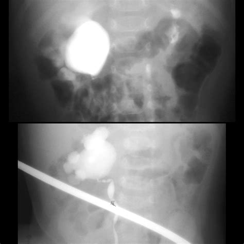 Pediatric Ureteropelvic Junction Obstruction Pediatric Radiology Reference Article Pediatric