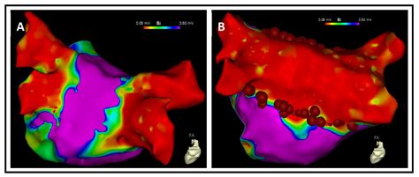 Jcm Free Full Text Focal Pulsed Field Ablation For Atrial