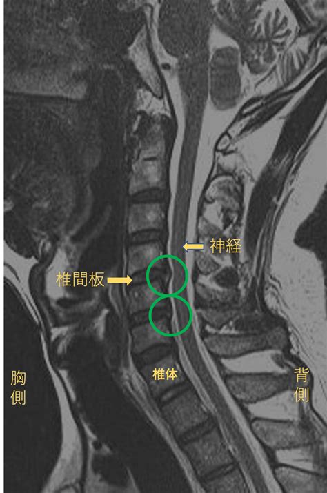 【pldd法】3か月前から右肩の痛み、右手のしびれがある40代男性【治療実績】 医療あれこれ日記 椎間板ヘルニアのレーザー治療