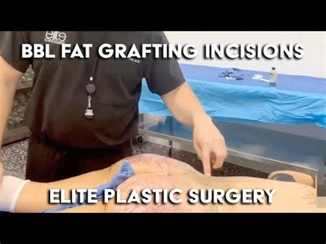 Bbl Fat Grafting Incisions Moises Salama Md Elite Plastic Surgery