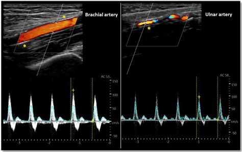 Doppler Mode Arterial Evaluation Brachial Left And Ulnarright