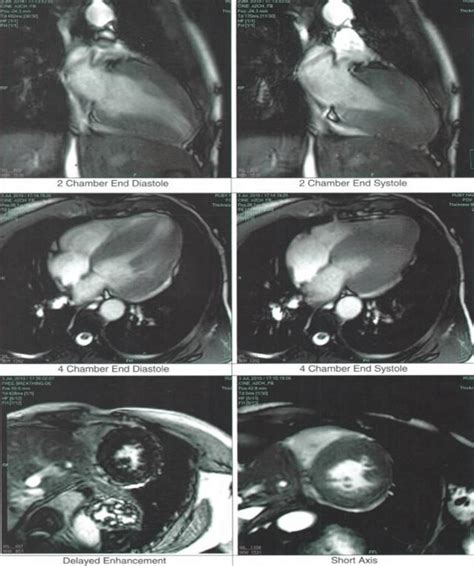 Circumferential Asymmetric Left Ventricular Hypertrophy With Mild RVOT