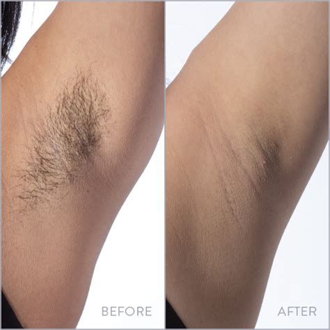 Underarm Laser Hair Removal Milan Laser In Wichita Ks