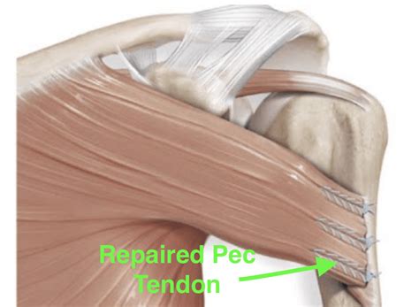 Pectoralis Tendon Surgery Dr Edward Weldon