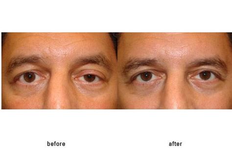 Male Patient Before And After Ptosis Repair For Drooping Upper Eyelid