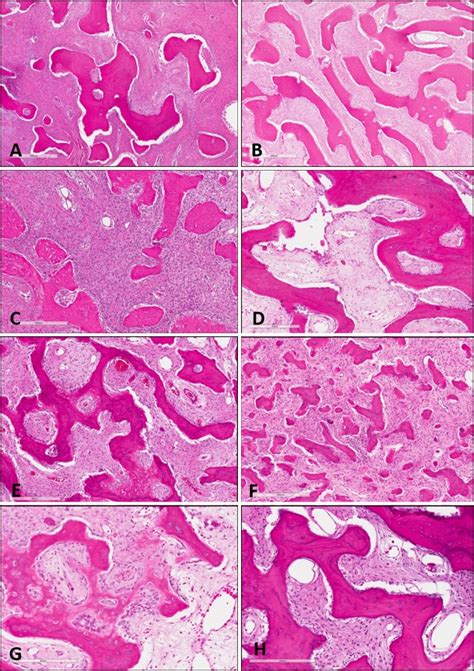 Polyostotic Fibrous Dysplasia Histology