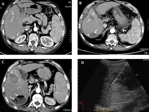 Patient With Child Pugh Class C Cirrhosis Who Underwent Mwa Treatment