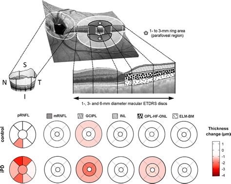 Progression of retinal atrophy in peripapillary peripapillary retinal ...