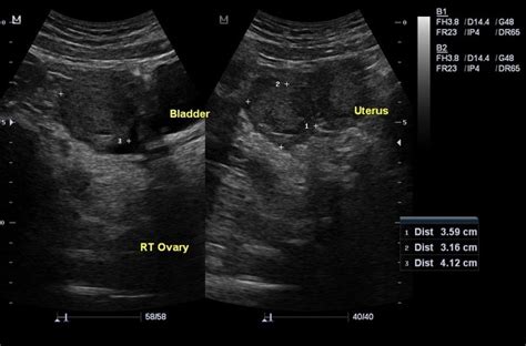 Cureus A Case Of Hemorrhagic Ovarian Cyst Rupture, 53% OFF