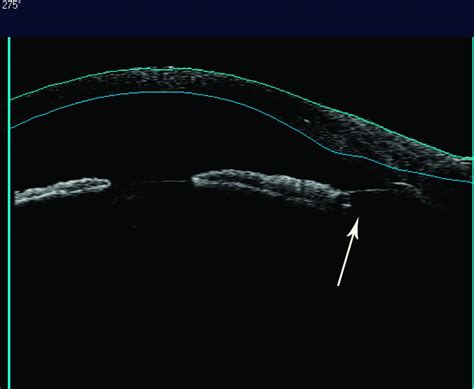 Combined Cataract Glaucoma Surgery Intechopen