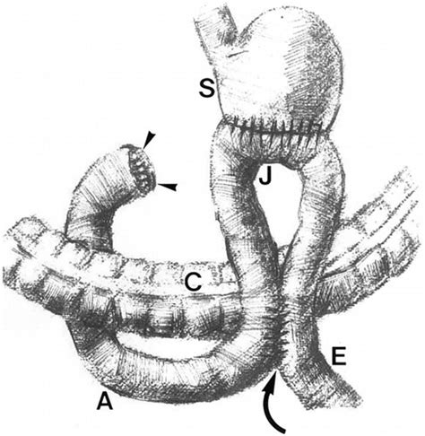 Total Gastrectomy With Roux En Y Esophagojejunostomy