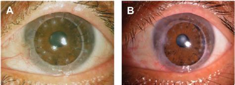 Clinical Appearance Of Candida Parapsilosis Keratitis After Pkp A 2 Download Scientific