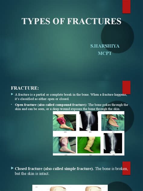 Types of Fractures | PDF | Medical Imaging | Bone