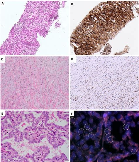 Ntrk Fusions In Solid Tumours What Every Pathologist Needs To Know