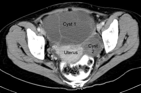 Ovarian Endometrioid Adenocarcinoma And Mucinous Cystadenoma