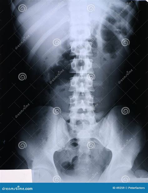 Xray/spine stock illustration. Illustration of film, lung - 49259