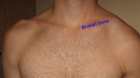 What Causes A Lump On My Collar Bone At Ed Simpson Blog