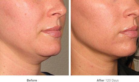 Microneedling Procedure Perfection Plastic Surgery And Skin Care