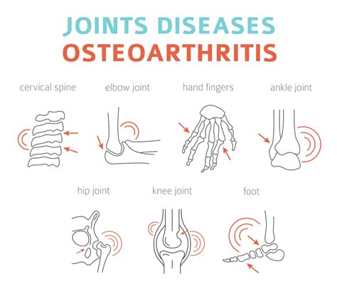 Osteoarthritis Surgery and Joint Replacement - Heiden Orthopedics