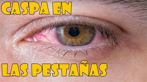 Caspa en las pestañas o blefaritis síntomas y tratamiento YouTube