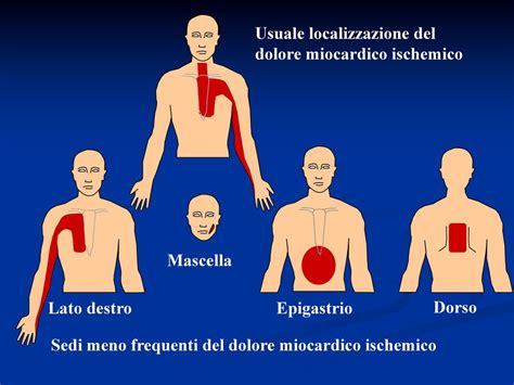 Cardiopatia Ischemica Ppt Scaricare