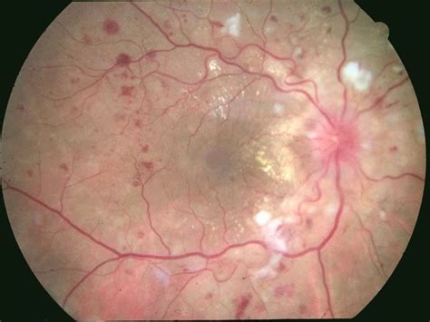 R Tinopathie Hypertensive Diagnostic Par Fond D Oeil Clinique