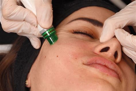 Facial Treatment Lebanon Crystal Care Clinic