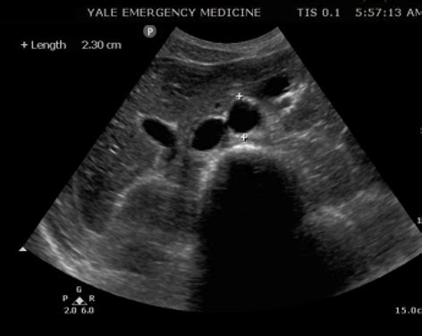 Aorta and IVC Ultrasound: Initial Visualization