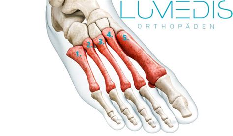 Mittelfu Prellung Lumedis Ihre Fu Spezialisten