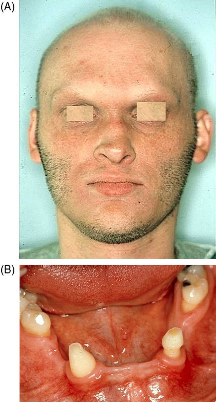 [PDF] Treatment of severe hypodontia-oligodontia--an interdisciplinary ...