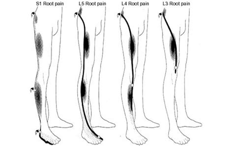 What Is Sciatica Types Of Sciatica Treatment Premia Spine Blog