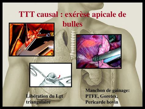 Ppt Traitement Chirurgical Du Pneumothorax Spontan Powerpoint