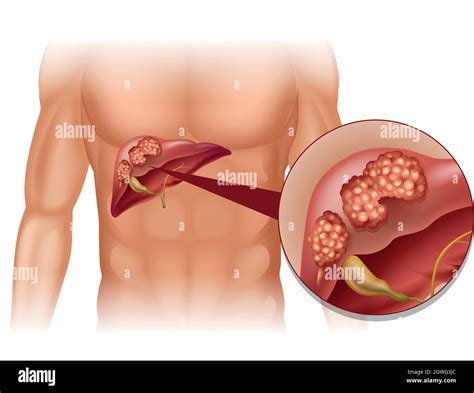 L Image Du Cancer Du Foie Banque De Photographies Et Dimages à Haute Résolution Alamy