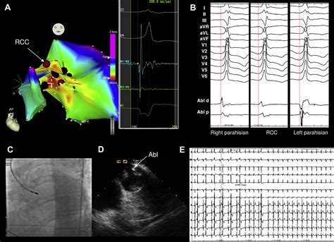 How To Map And Ablate Parahisian Ventricular Arrhythmias Heart Rhythm