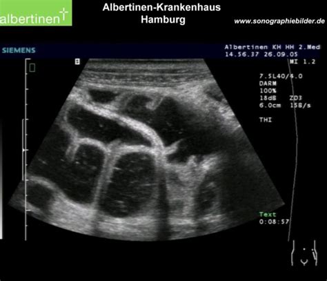 Dickdarm Ileus Sono DocCheck