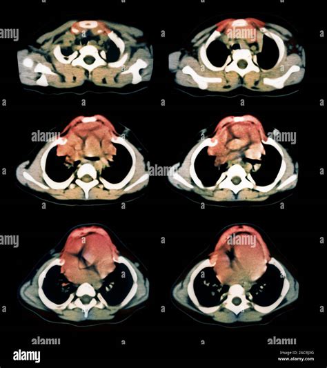 Jeune Sindrome Colorato La Tomografia Computerizzata Ct Scansioni