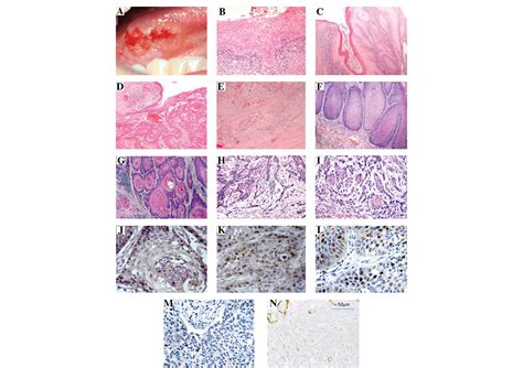 Esophageal Squamous Cell Carcinoma Histology