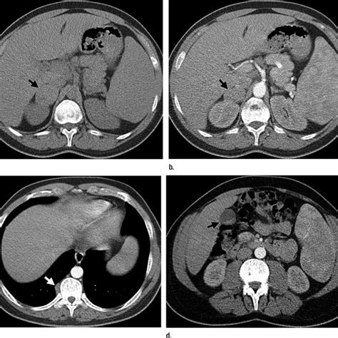 Right Adrenal Mass Resection Specimen A Macroscopic Image Shows A